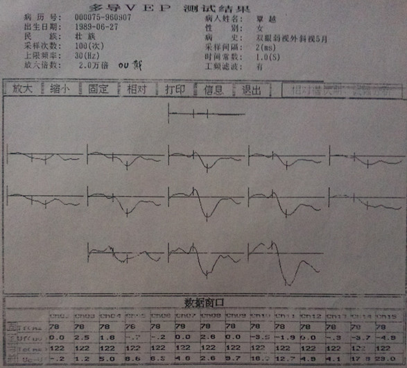 天津市何琪中医按摩治疗远视散光弱视的病例之一