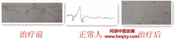 何琪中医按摩能够改善VEP形态