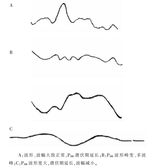 异常的VEP形态