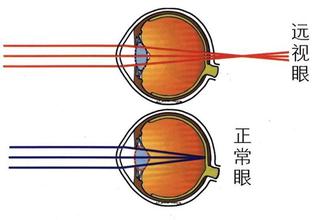 治好远视的唯一方法就是促进眼轴生长