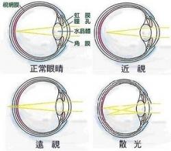 形成散光主要和角膜生长不成熟有关