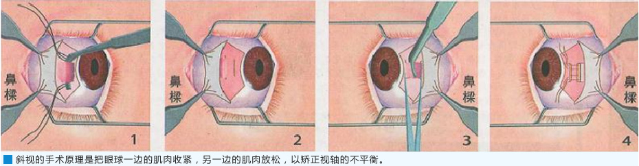 斜视手术原理