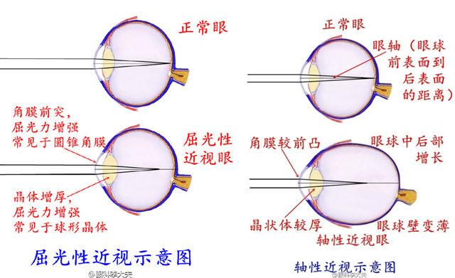 屈光性近视和轴性近视对比