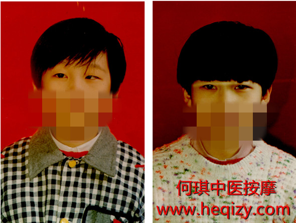 中医按摩是治疗儿童弱视斜视的最好方法