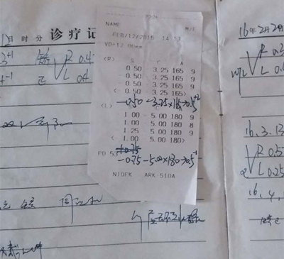 3岁多的贝儿被诊断为高度散光弱视