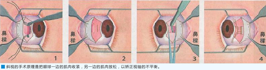 斜视手术的作用原理