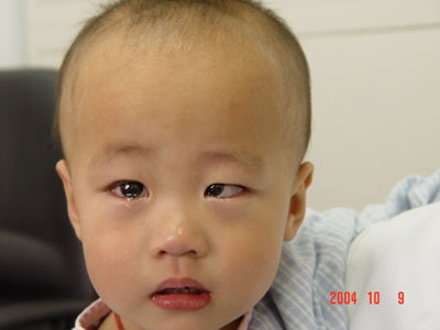 斜视手术给孩子造成了更大的伤害