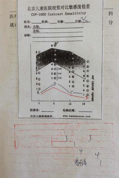 润宝治疗后的视觉对比敏感度（CS）检查