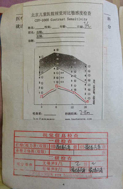 润宝治疗后的视觉对比敏感度（CS）检查