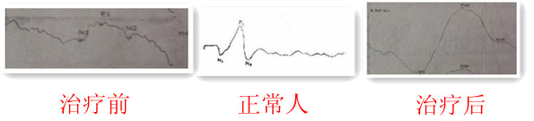 何琪中医按摩可以改善视觉诱发电位形态